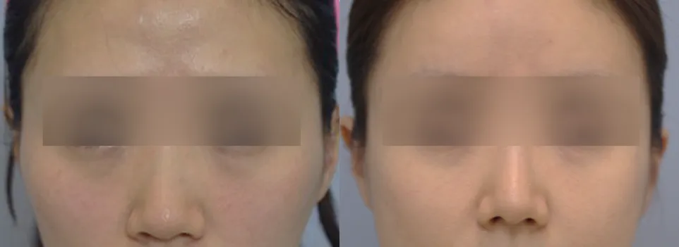 Face from the front before and 2 months after cheekbone reduction