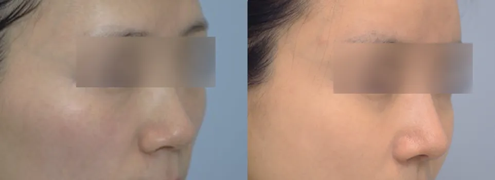 Face at 45 degrees before and 2 months after cheekbone reduction