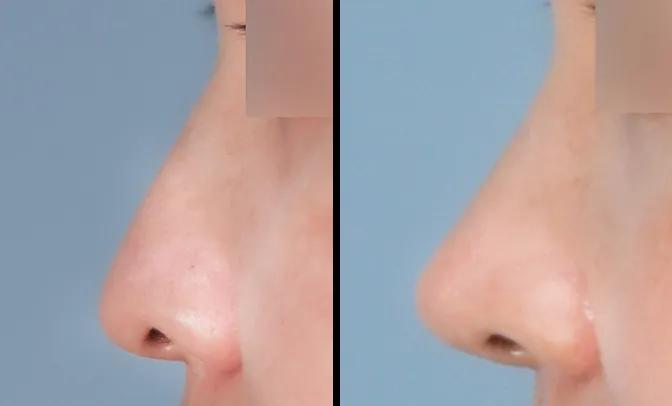 Nose profile before and 1 month after closed rhinoplasty with a higher, straighter bridge