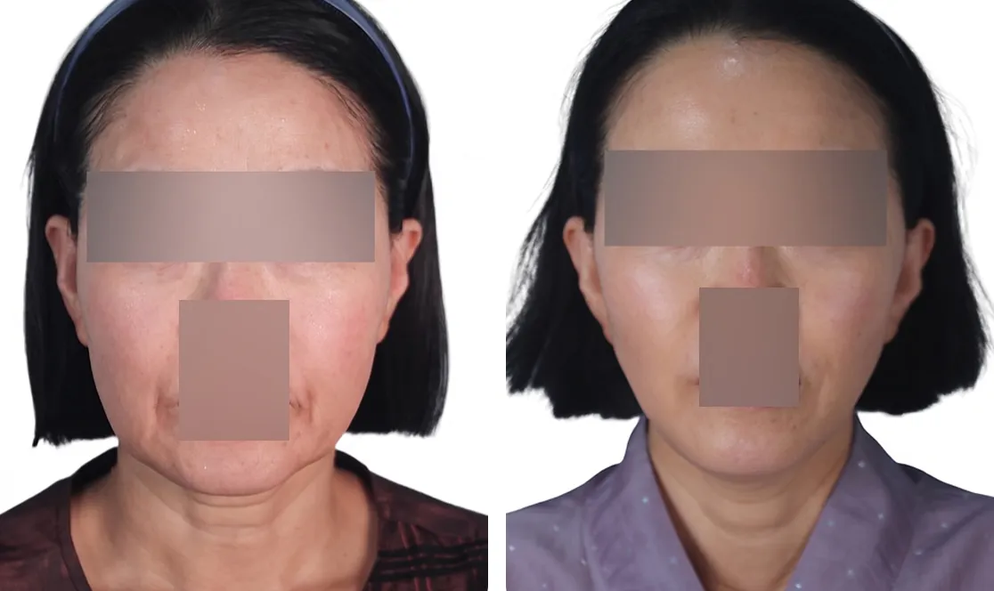 Woman's face before and 2 months after a double deep-plane facelift with a firmer jawline