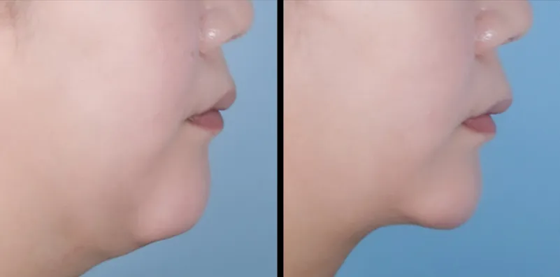 Profile before and 1 month after double-chin liposuction with platysma tightening