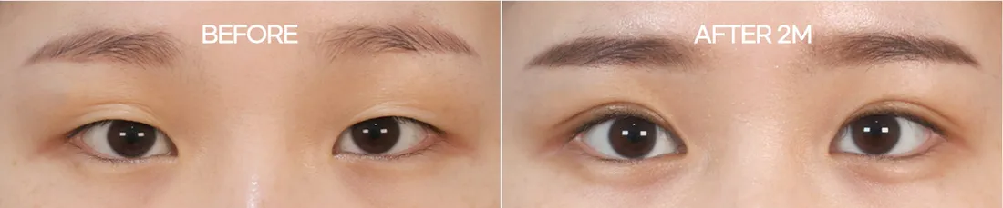 Before and 2 months after minimal-incision double-eyelid surgery, close-up of both eyes