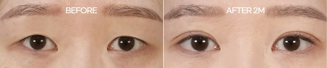 Second case before and 2 months after minimal-incision double-eyelid surgery