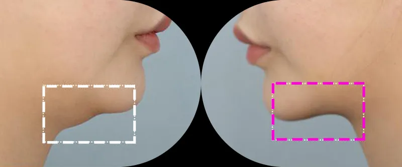 Under-chin area before and 2 weeks after InMode FX treatment