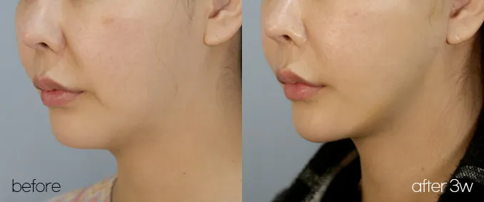 Oblique view before and 3 weeks after a mini facelift with a tighter jawline
