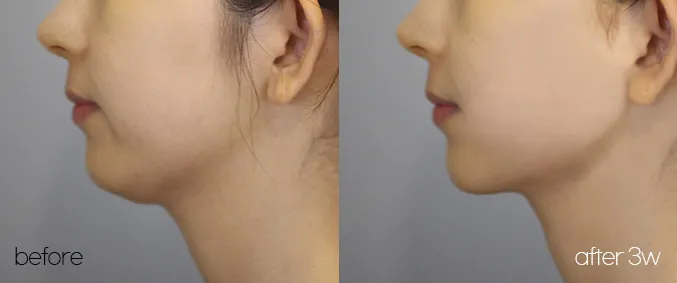 Profile before and 3 weeks after a mini facelift with a sharper jaw-neck angle