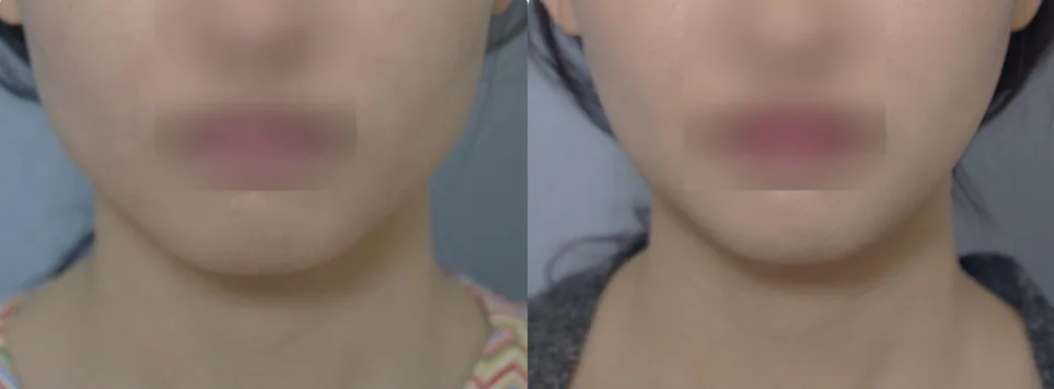 Lower face before and 2 months after square jaw reduction with a softer jawline