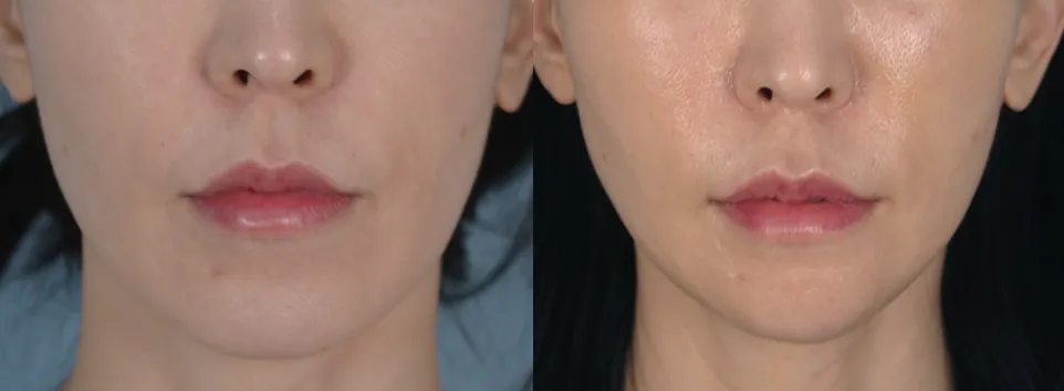 Lower face before and 2 months after V-line contouring with a narrower chin